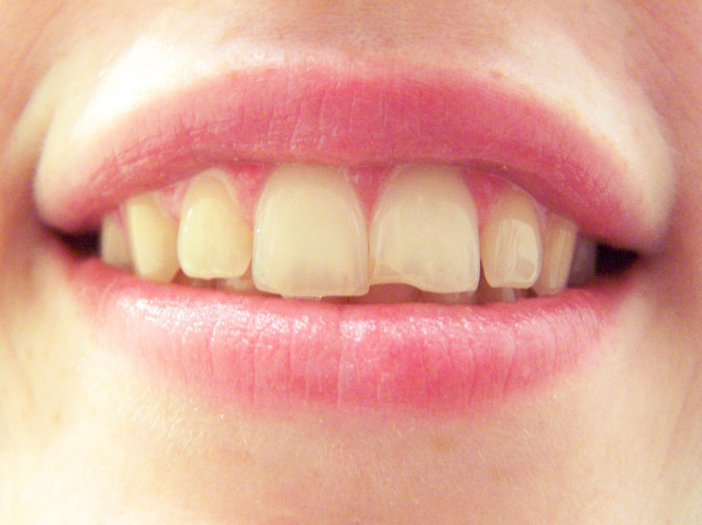 yellowish chipped tooth